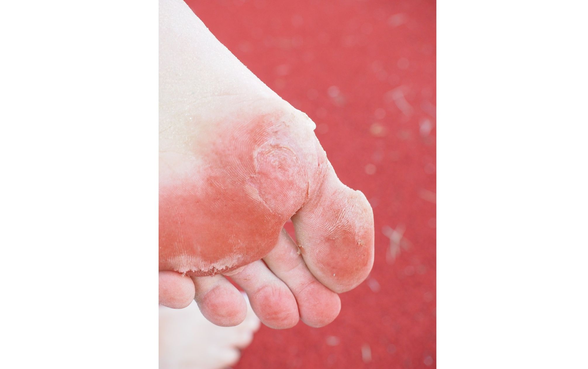 18 Inexpensive and Natural Home Remedies for Athlete’s Foot