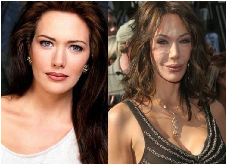 25 Once Beautiful Celebs With Horrible Plastic Surgery