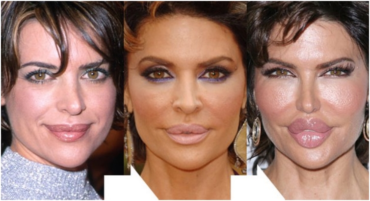 25 Once Beautiful Celebs With Horrible Plastic Surgery Jobs