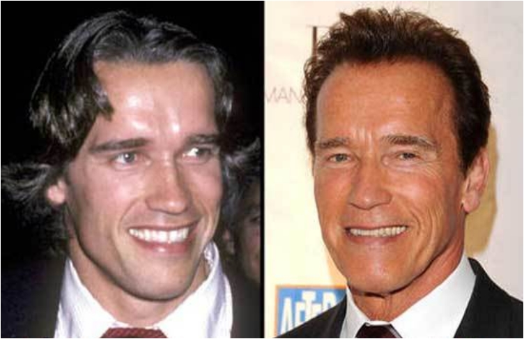 Famous Men Who Have Done Plastic Surgery Ritely