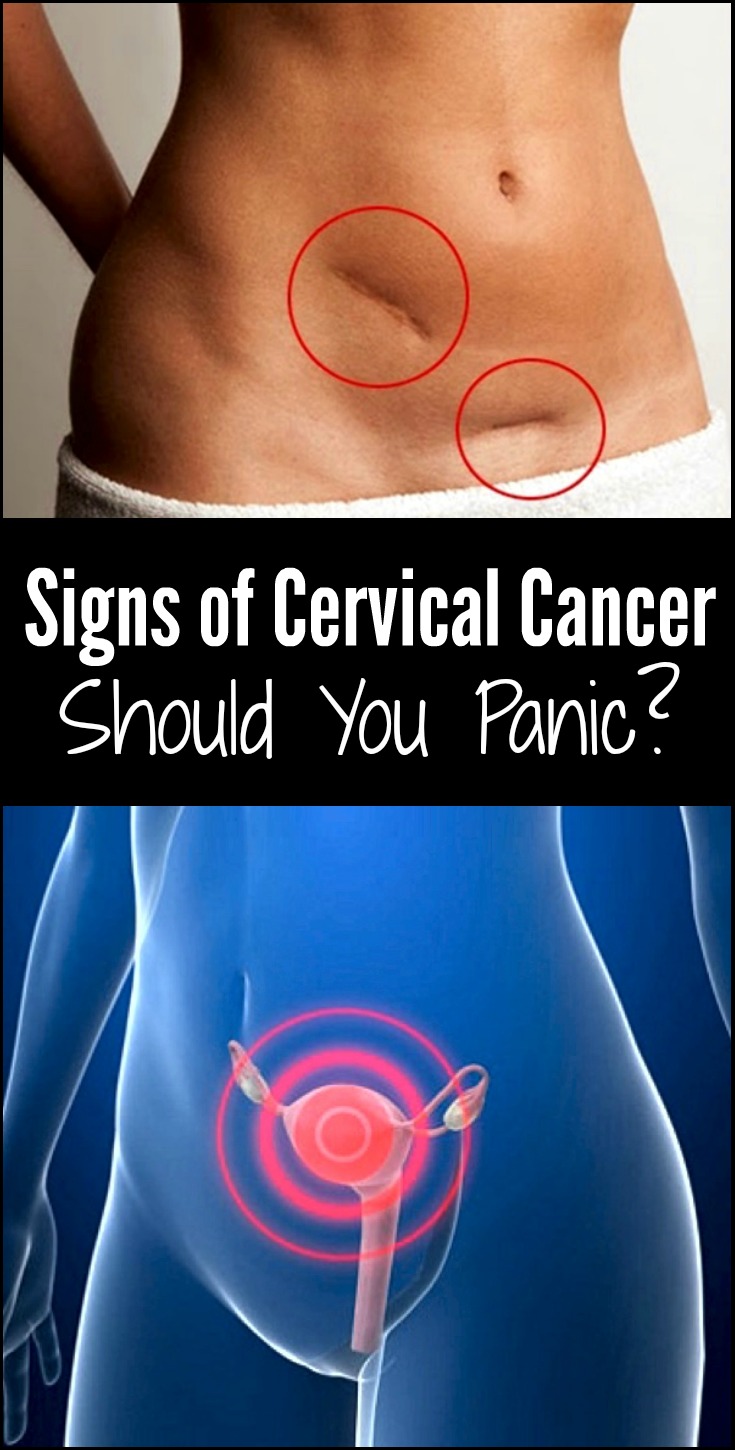 Signs of Cervical Cancer: Should You Panic?