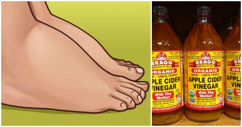 Swollen Feet Remedy