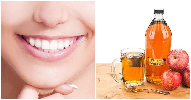 gingivitis-and-tartar-problems-these-vinegar-remedies-can-help