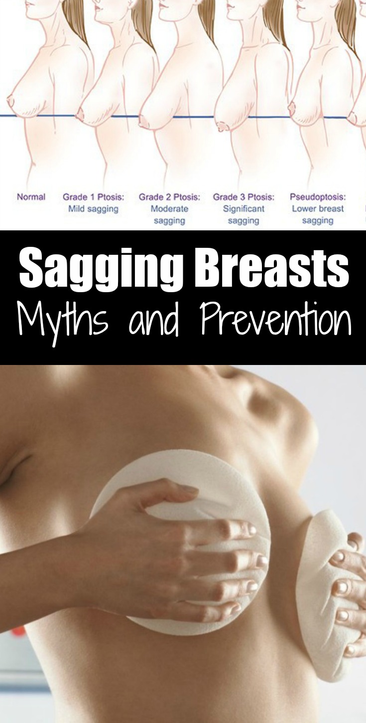 Sagging Breasts: Myths and Prevention