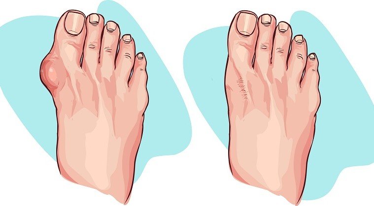 Reduce bunion size naturally