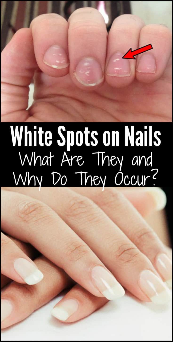 White Spots on Nails: What Are They and Why Do They Occur?