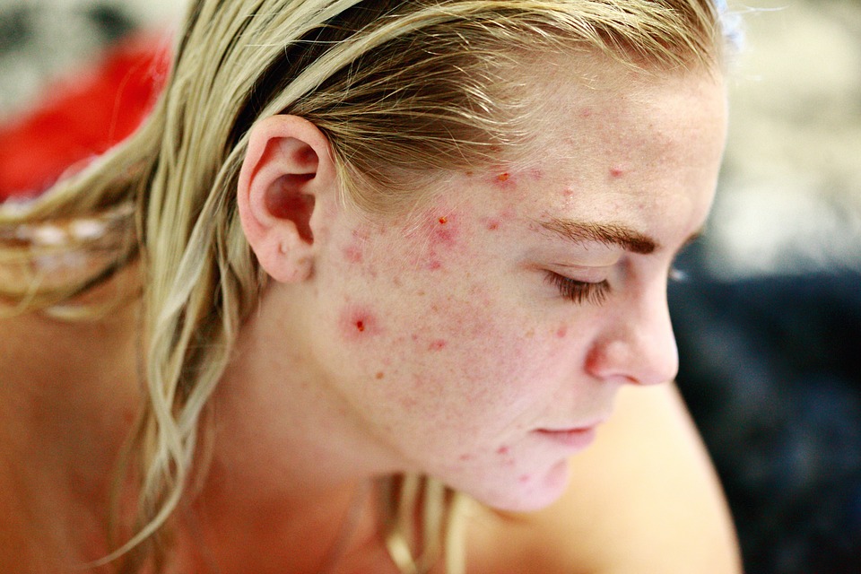 Essential Oils for Acne: Which Are Best, How to Use Then, and Possible Side Effects