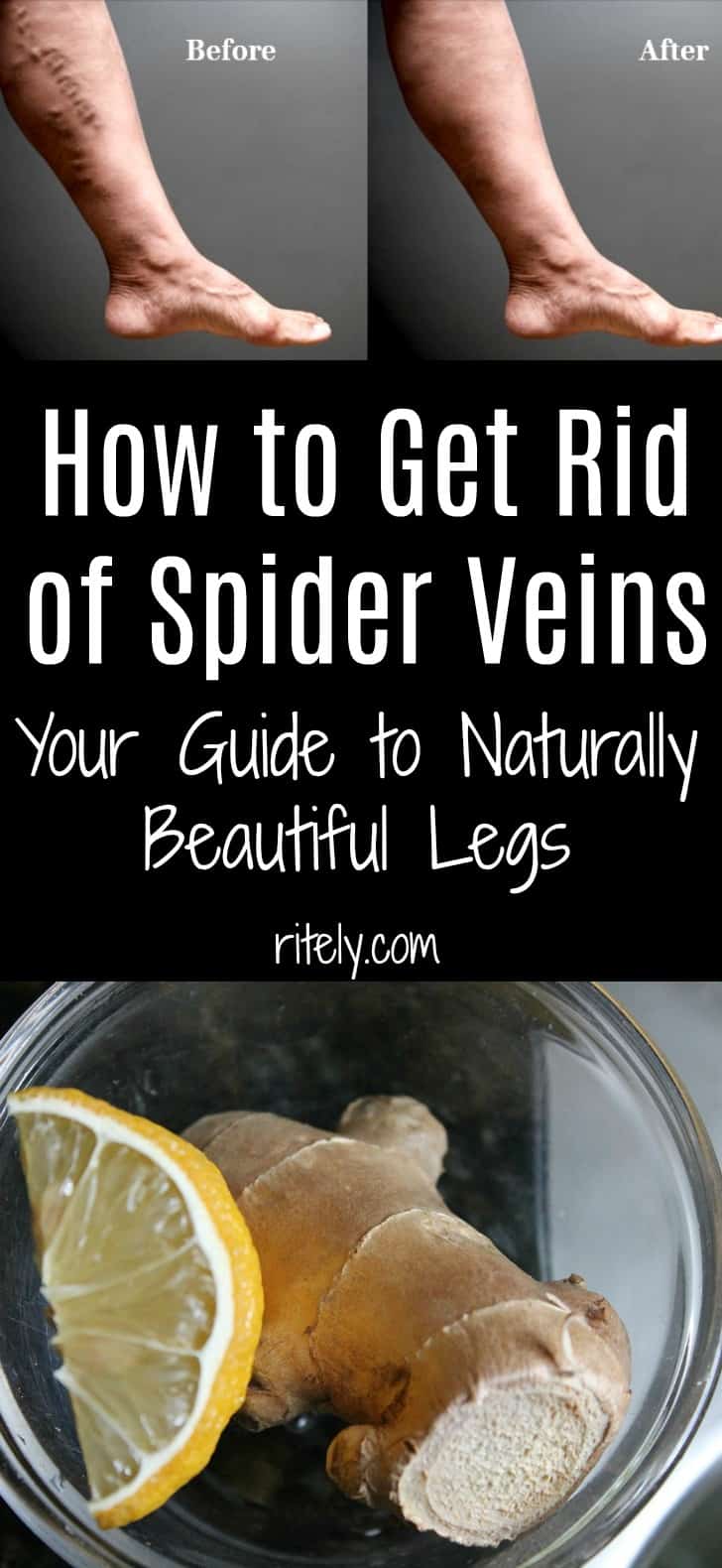 How to Get Rid of Spider Veins: Your Guide to Naturally Beautiful Legs