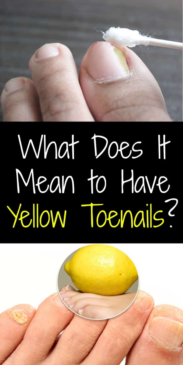 What Does It Mean to Have Yellow Toenails? Treatment and Causes!